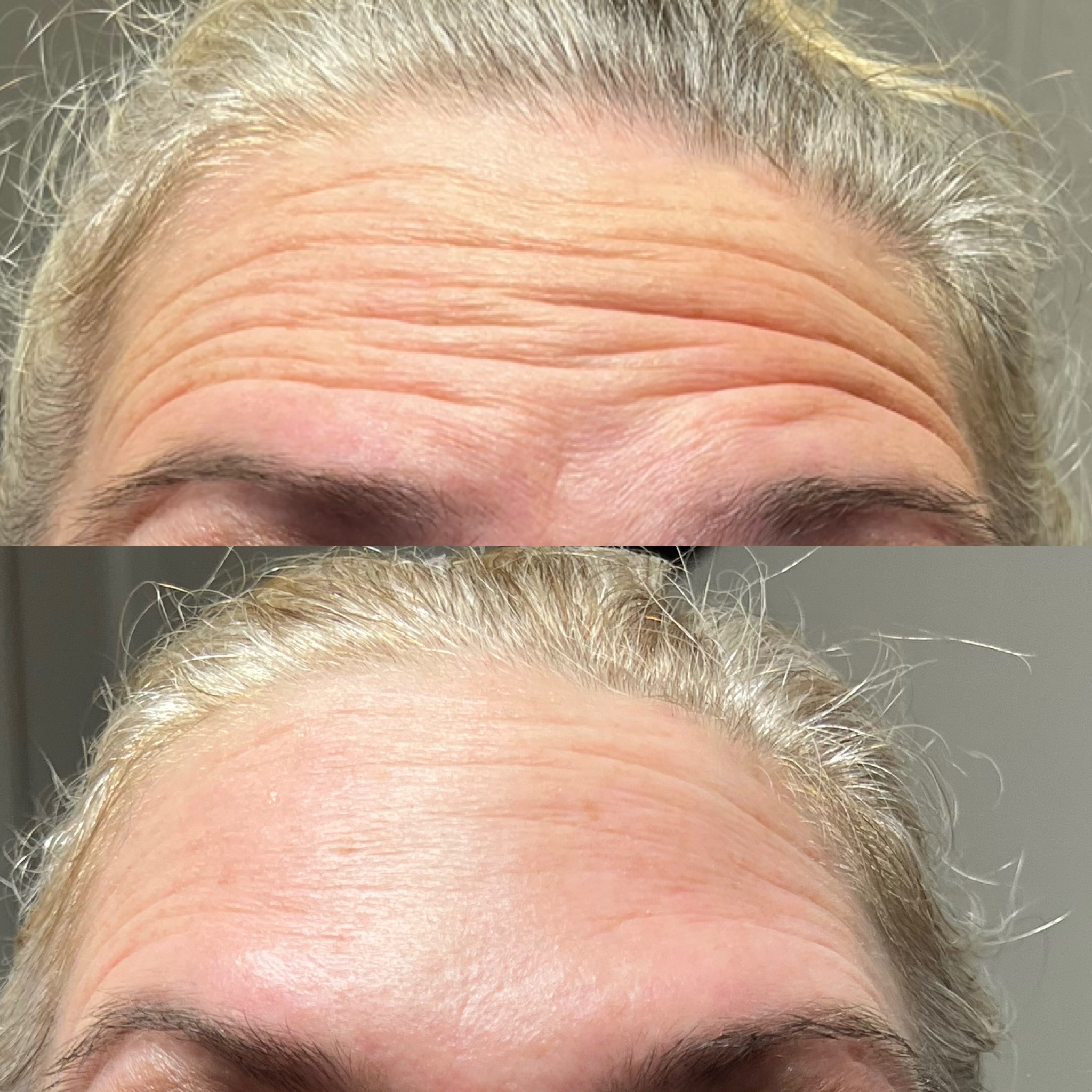 Botox in Unionville, PA